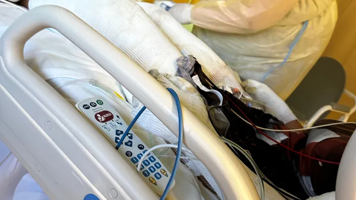 1 adolescente hispana sufrió quemaduras en su cuerpo luego que otro adolescente lanzara una pipa de combustible a una fogata. Ahora, su madre busca ayuda para su recuperación