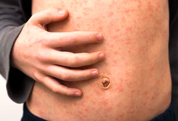 measles sarampion macon